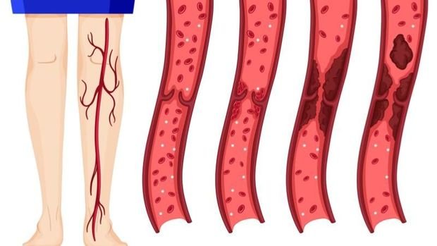 Koronavirusun daha bir fəsadı aşkar edildi