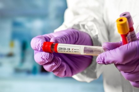 Azərbaycanda daha 75 nəfərdə koronavirus aşkarlandı
