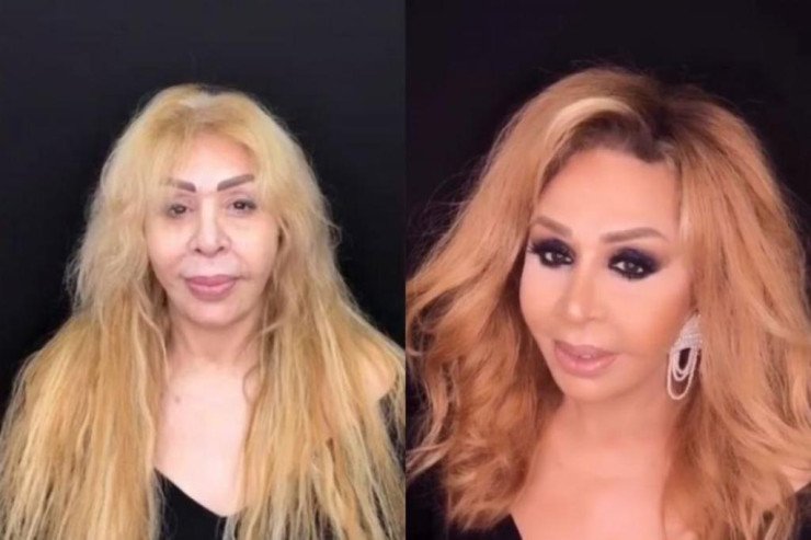 Əməkdar artist estetik əməliyyatın qurbanı oldu: "Çox peşmanam..."