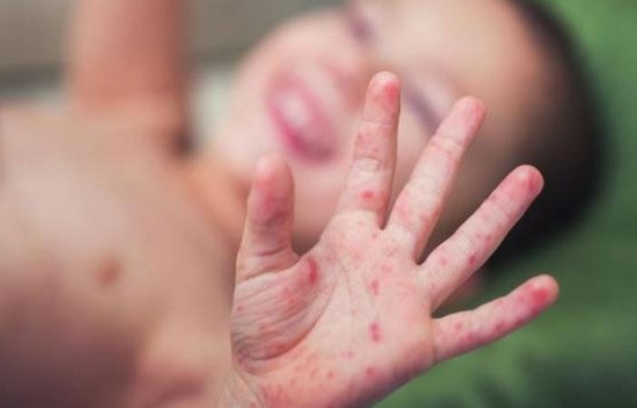Qızılca və qrip ölkədə epidemiya səviyyəsinə çatır - səbəb...
