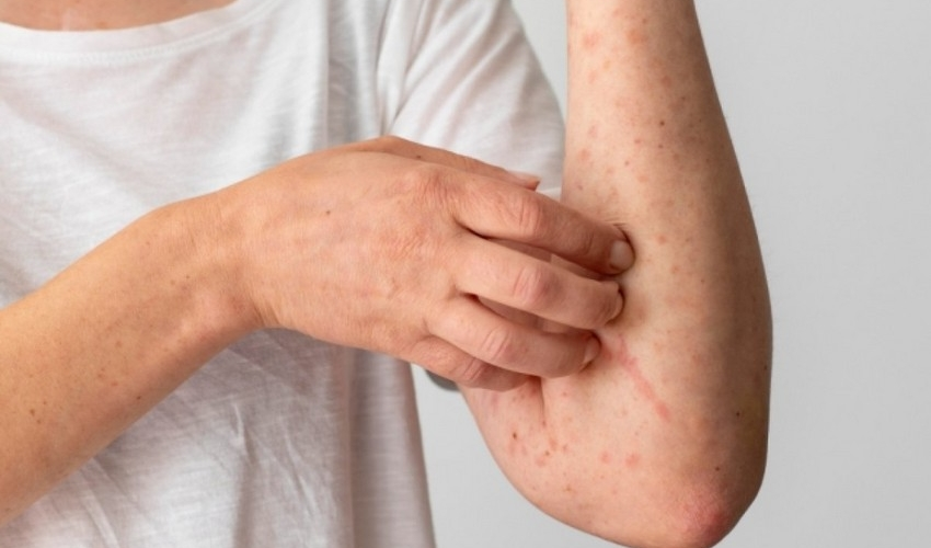 Həkimdən qızılca ilə bağlı MÜHÜM MƏSLƏHƏT