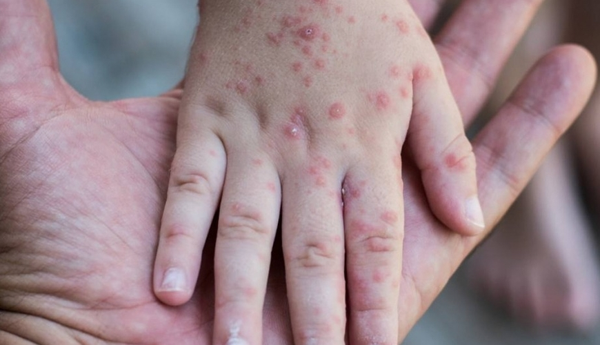 Həkimlərdən SOS: Uşaqlar arasında qızılca artır, daha bir neçə virus yayılıb...