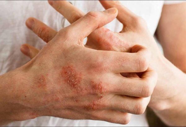 Yazda hansı dəri problemləri yaranır? - 3 önləyici TƏDBİR