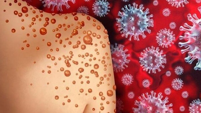 Azərbaycanlı alimdən "Meymun çiçəyi" ilə bağlı şok AÇIQLAMA