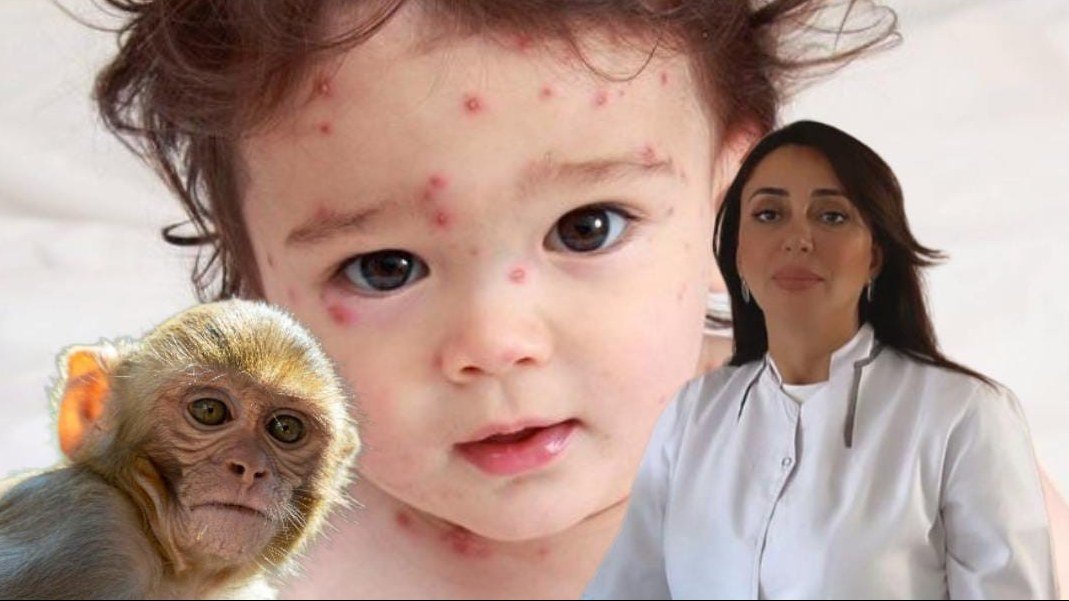 Həkimlərə HƏYƏCAN SİQNALI verildi: uşaqlar arasında yeni virus YAYILACAQ
